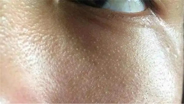长在眼周的毛周角化有人也叫它"脂肪粒",其实可以算是一种密集型粉刺