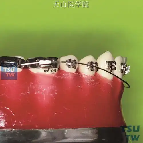 正畸摇椅弓的弯制