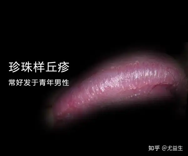 珍珠疹和尖锐湿疣图片区分