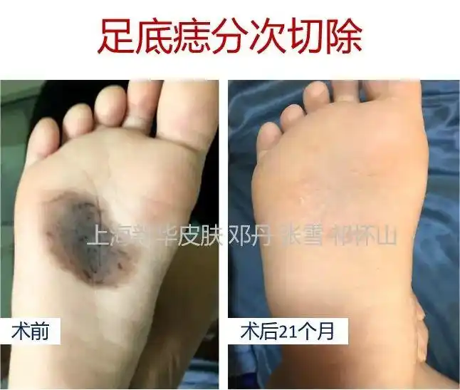 皮损相对规则,临床考虑良性,病理活检为交界痣,行预防性切除,考虑中间