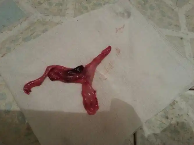 最近来大姨妈,随着经血出来一块息肉一样的肉,真的像肉,而不是血块