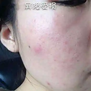 问题肌肤,为什么一般都和皮肤屏障受损有关?