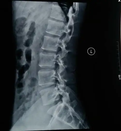 摔了一跤怀疑尾骨骨折或骨裂,去拍了片子遇到个庸医