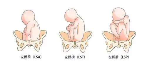 医生,宝宝的胎位正吗