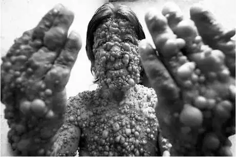 因治疗手段有限,如今全身长满纤维瘤