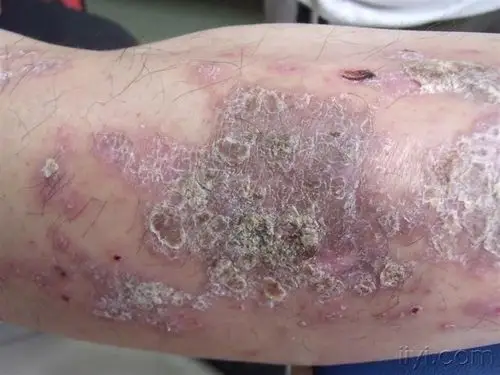 扁平苔癣 - 皮肤及性传播疾病讨论版 - 爱爱医医学论坛