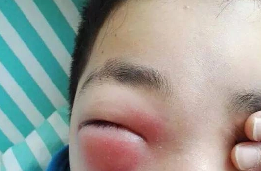 肾病眼肿和普通眼肿,有什么区别?医生提醒:两种差别大,别混淆