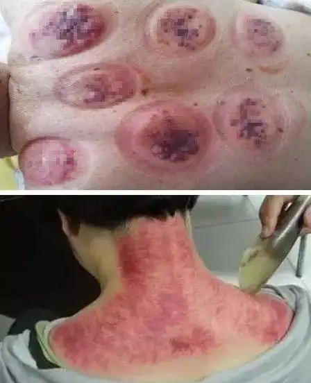 传统拔罐刮痧虽有效,但是刮痧得喊疼妈,拔火罐风险又特别大!
