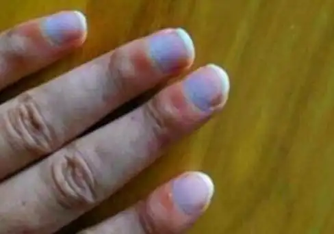 林赛氏指甲是尿毒症吗?