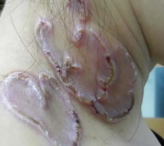 三期梅毒的症状是什么图片_有来医生