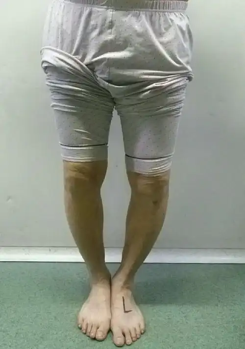 膝内翻(o型腿)的治疗