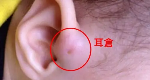 她宝宝耳朵上有「耳仓」,人人都说是福气的表徵!