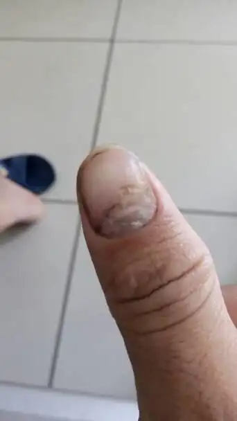 我想请问一下,我这个手指甲怎么回事?缺钙吗?还是我得了什么疾病?