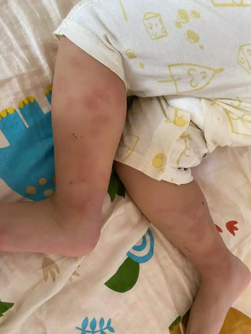 今天四天了,还是没见好.腿上的疙瘩又硬 - 抖音