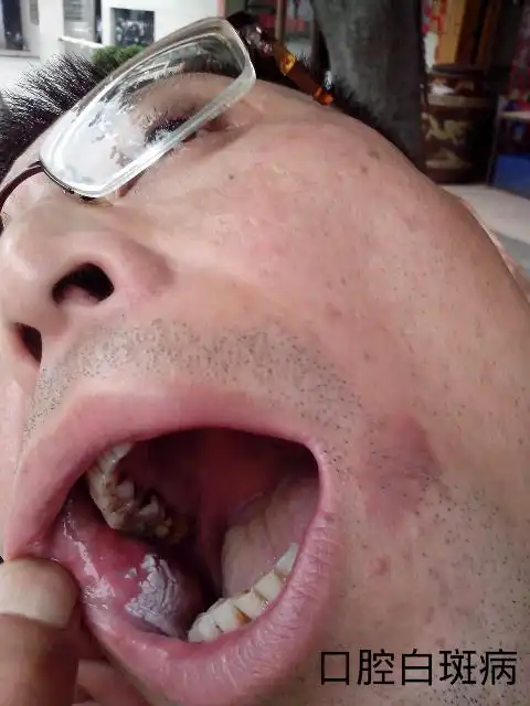 这是口腔白斑吗