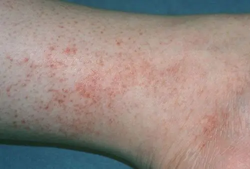 艾滋病红斑图片 (59)