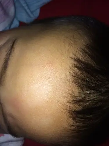 宝宝额头长的白斑是什么