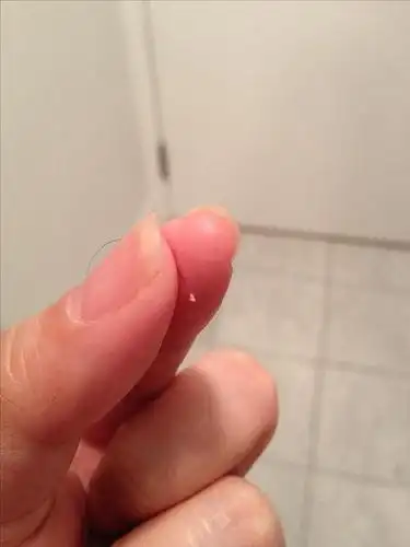 我之前掉的头发都是没有这个白色固体的.这个叫毛囊?