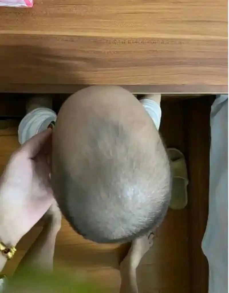 24岁的沈小姐,生下孩子后,一家人发现孩子的头比较尖.