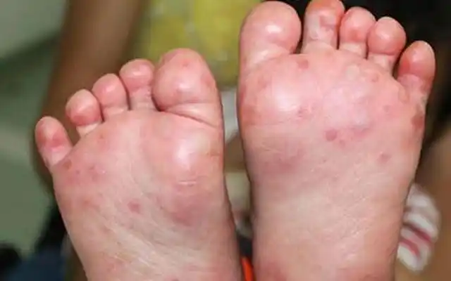 手足口症状 (14)