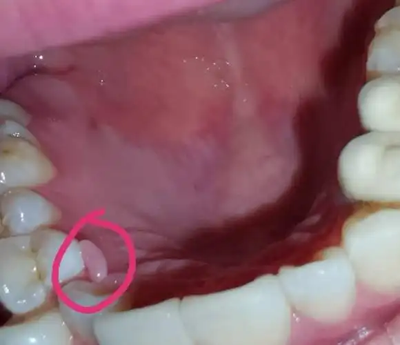 最近突然发现牙齿那里长了一个像肉的东西,不痛不痒的,怎么处理?