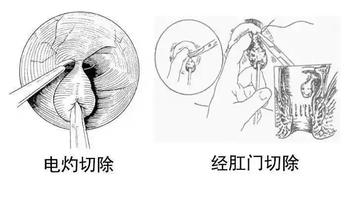 体检发现肛门息肉,不痛不痒要治吗?