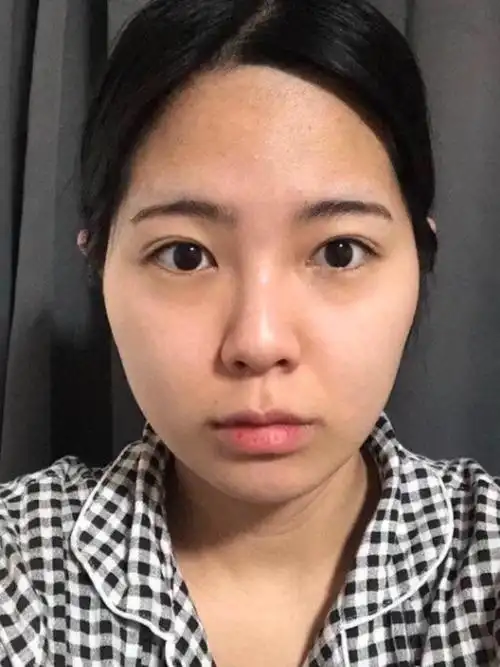 以前总羡慕别人有一个好看的小鼻子 ,现在自己也有了_圈子-新氧美容