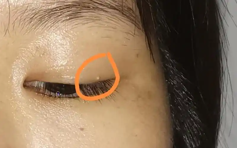 求助,眼皮不知道为什么长了一颗白色颗粒,有人知道这是什么嘛?