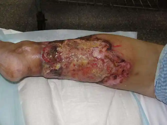 咨询电话:13683507852.术后两周,左大腿供皮创面甲级愈合.