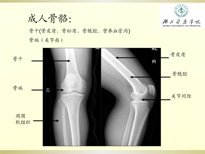 常见骨关节疾病影像复习课程.pptx