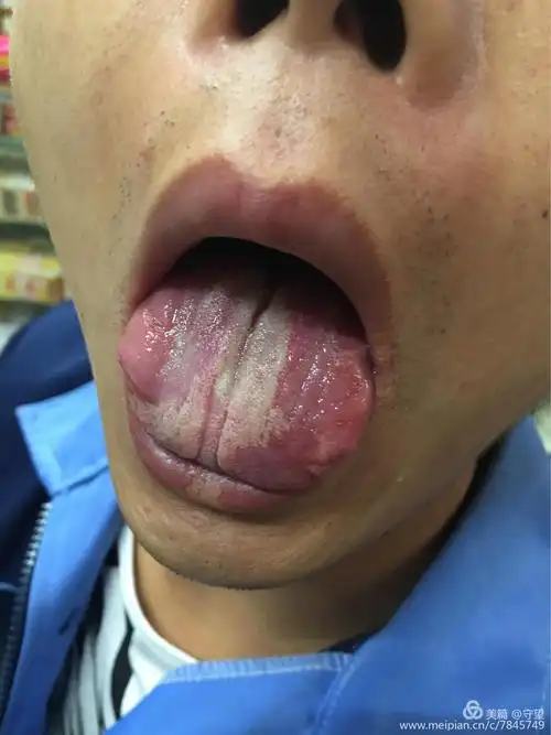 舌像图,近一年来经历过病人的舌像.