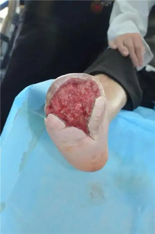 到多个脚趾,最后累及到整个前半个脚掌,并且还有不断上行感染的趋势