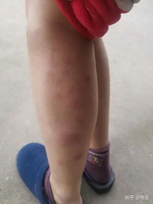 得过结节性红斑的人过来交流下? - 知乎