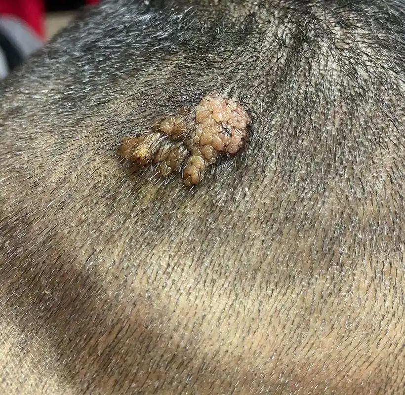 菜花状头皮疣切忌手欠!