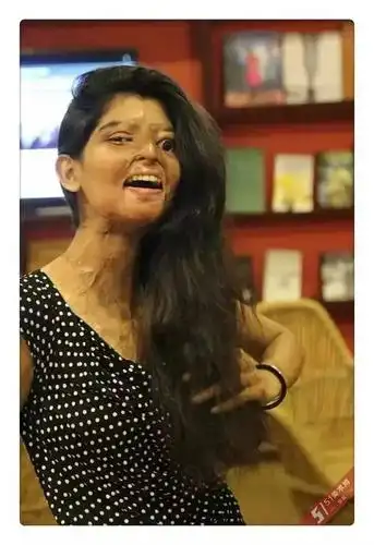 这些印度美女被泼硫酸毁容后没有自杀依然美丽的活着