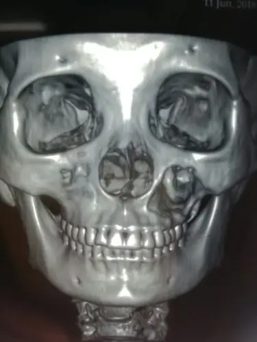 口腔科耳鼻喉科合作完成一例巨大上颌骨囊肿切除术