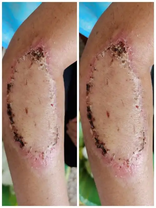 车祸前臂皮肤缺损,大腿取皮植皮,皮片成活良好.