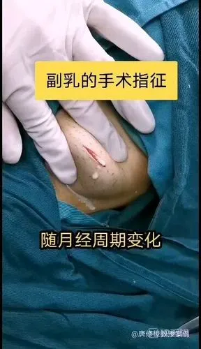副乳什么时候需要手术治疗_副乳