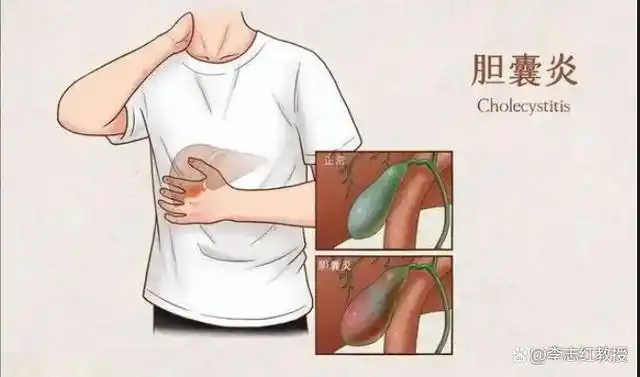 胆囊炎可以逆转吗?听听专家怎么说
