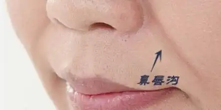 鼻唇沟太深怎么办?鼻唇沟填充方法哪种好?