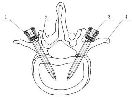 一种自转式椎弓根螺钉-爱企查