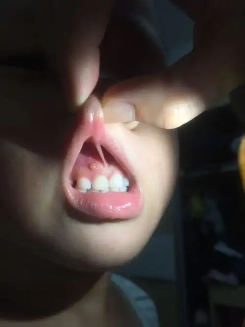 我儿子牙龈上长了个包,他说不疼,挺担心的.