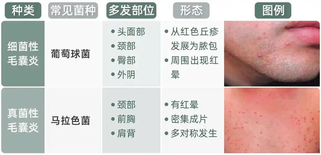 毛囊炎,顾名思义就是毛囊发炎,常见的感染性毛囊炎是由细菌或真菌感染