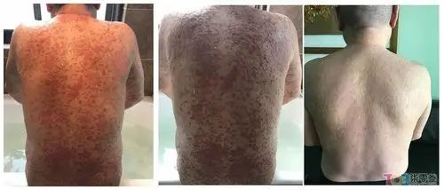 怎样治好牛皮癣?