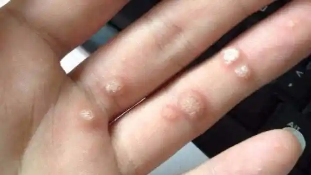 你身上长过瘊子吗?只需1个小方法,就能轻松去除瘊子,快试试