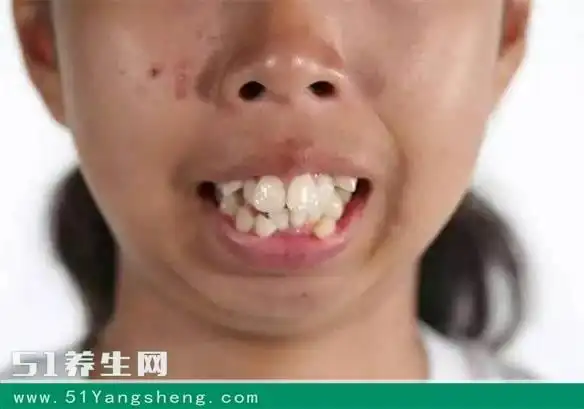 龅牙妹整容后变"大美女",嫁给了富二代,爱情事业双丰收