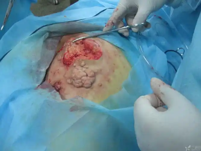 【讨论】刚做完的一例巨大皮肤纤维瘤 [精华] [病例帖]