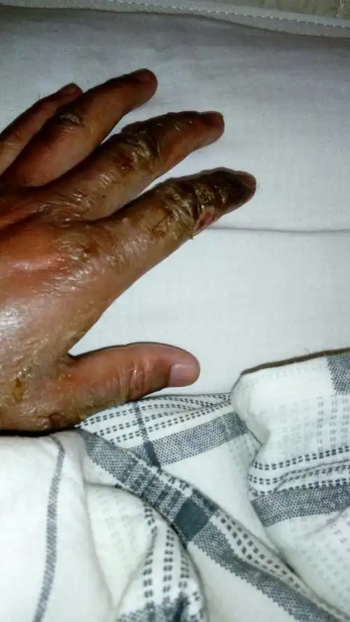 昨天手被电短路烧伤死皮大部分还在可以吹空调吗