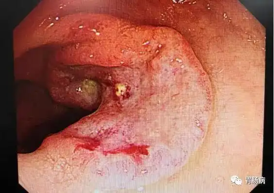 "假出血"查出来真肠癌!_黑便_结肠癌_医脉通