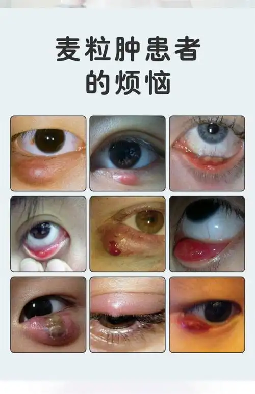 奔泰hb护理液麦粒肿睑腺炎决明子红肿发l炎抑菌滴l眼l液眼箹水15ml